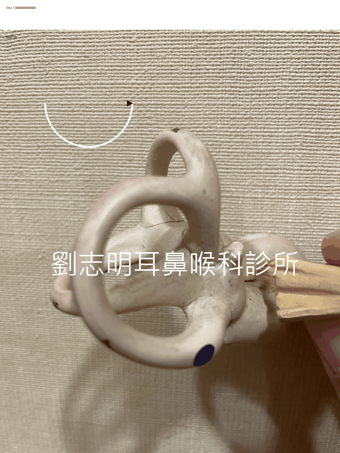 耳石脫落症引起的眩暈